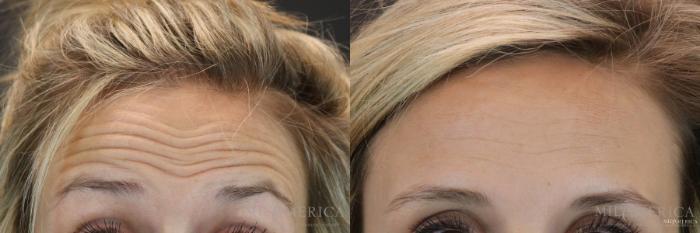 Before & After Botox/Dysport Case 154 View #1 View in St. Louis, MO