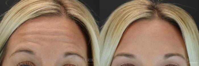 Before & After Botox/Dysport Case 155 View #1 View in St. Louis, MO