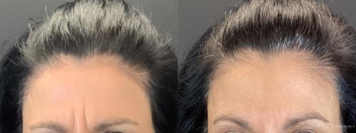 Before & After Botox/Dysport Case 346 Front View in St. Louis, MO