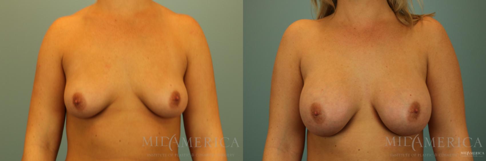 Before & After Breast Augmentation Case 139 View #1 View in Glen Carbon, IL