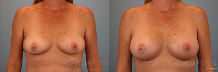 Before & After Breast Augmentation Case 140 View #1 View in Glen Carbon, IL