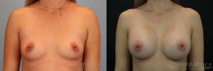 Before & After Breast Augmentation Case 152 View #1 View in Glen Carbon, IL