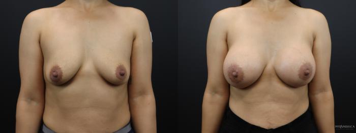 Before & After Breast Augmentation Case 266 Front View in Glen Carbon, IL