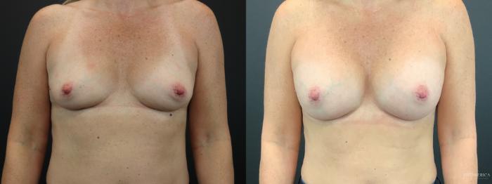 Before & After Breast Augmentation Case 268 Front View in Glen Carbon, IL