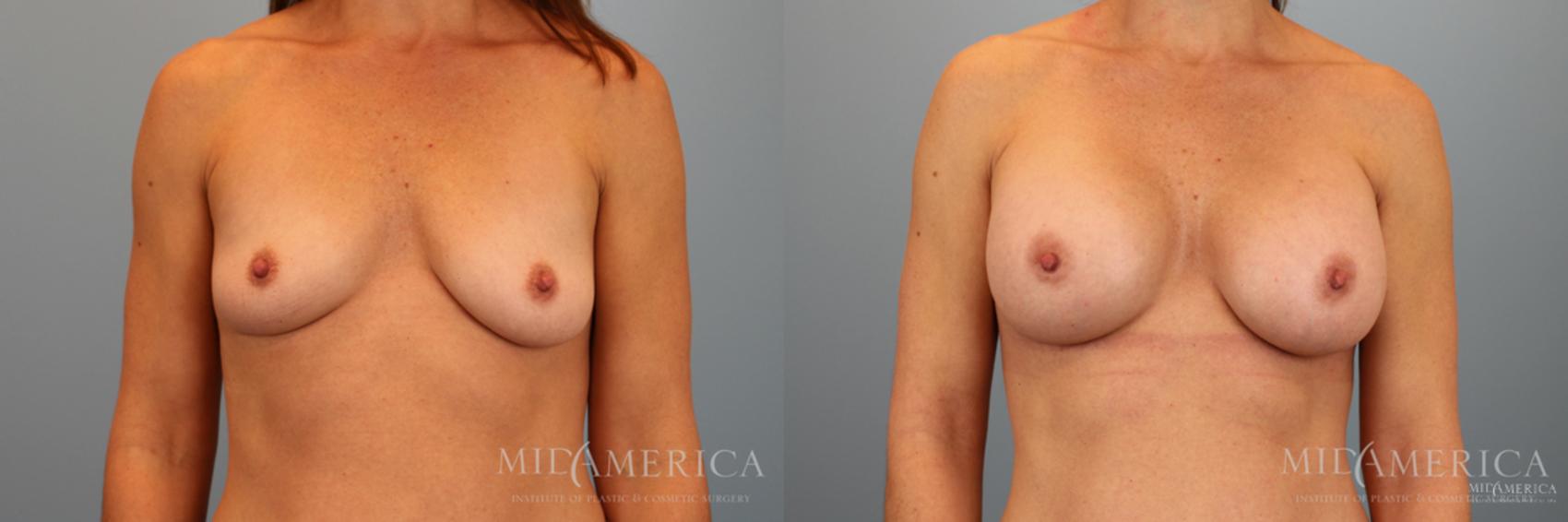 Breast Augmentation Case 40 Before & After View #1 | Glen Carbon, IL | MidAmerica Plastic Surgery
