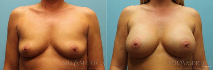 Before & After Breast Augmentation Case 97 View #1 View in Glen Carbon, IL