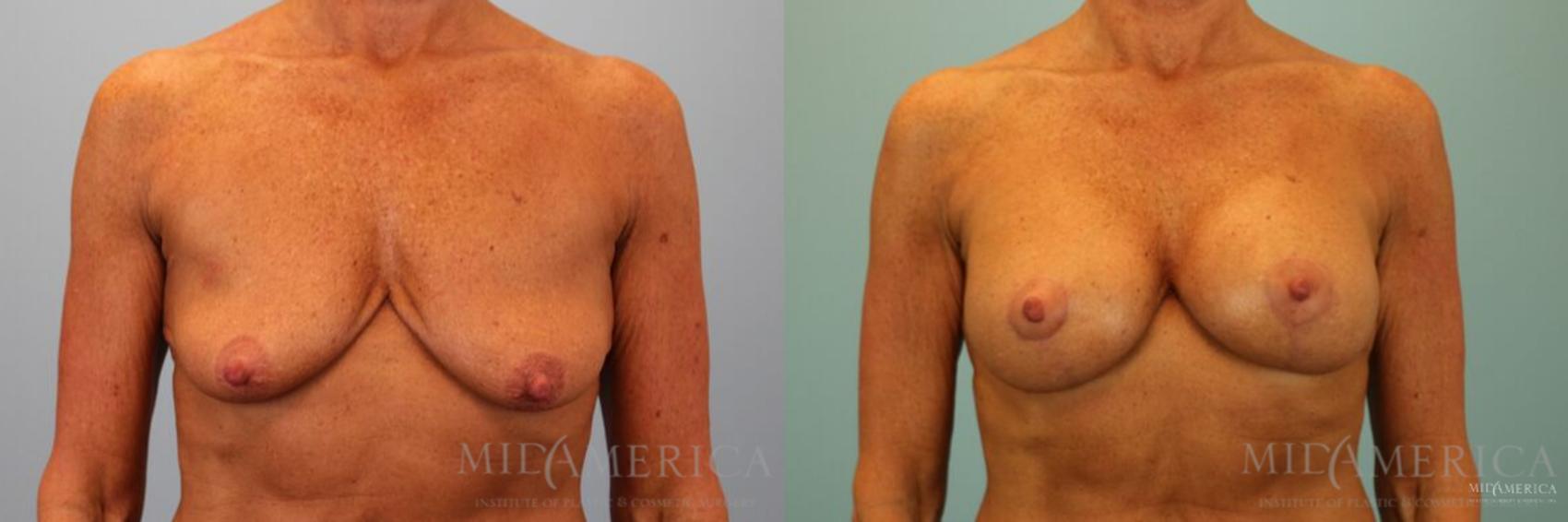 Before & After Breast Lift Case 128 View #1 View in Glen Carbon, IL