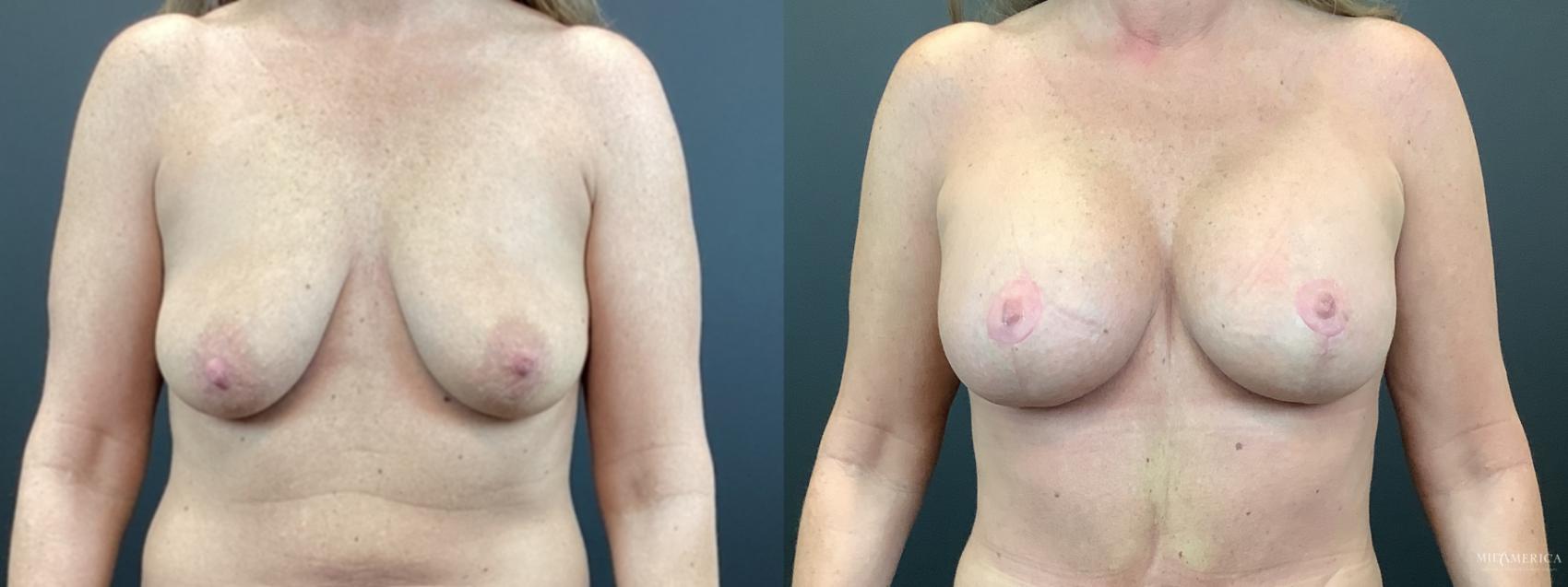 Before & After Breast Lift Case 329 Front View in Glen Carbon, IL