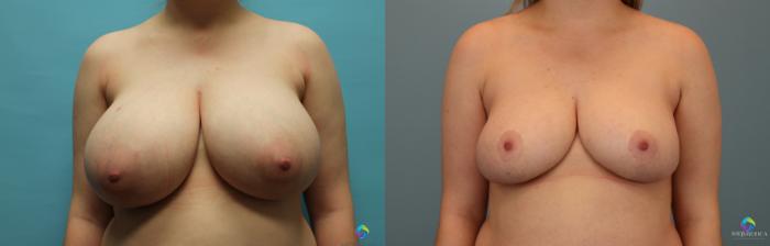 Before & After Breast Reduction Case 21 View #1 View in Glen Carbon, IL