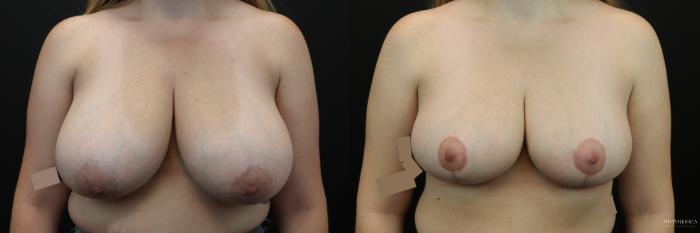 Before & After Breast Reduction Case 245 Front View in Glen Carbon, IL
