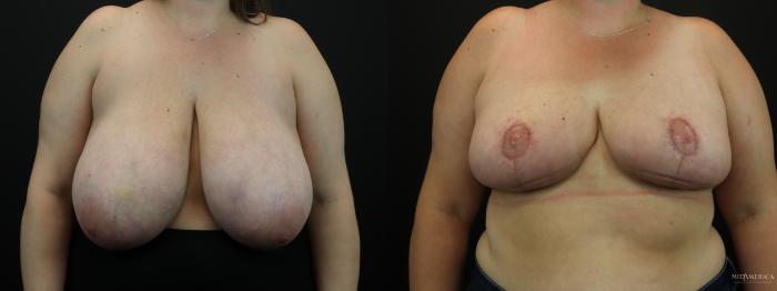 Before & After Breast Reduction Case 256 Front View in Glen Carbon, IL