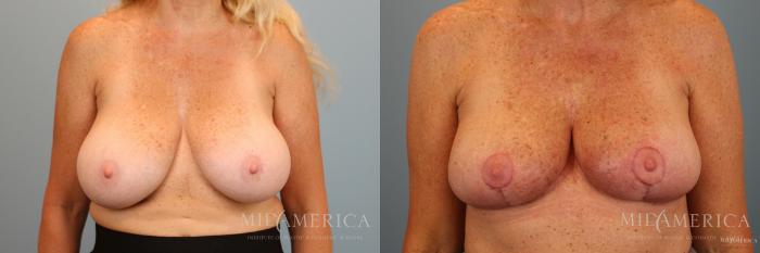 Before & After Breast Reduction Case 37 View #1 View in Glen Carbon, IL