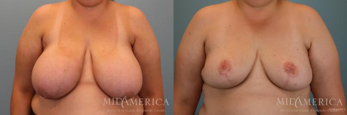 Before & After Breast Reduction Case 66 View #1 View in Glen Carbon, IL