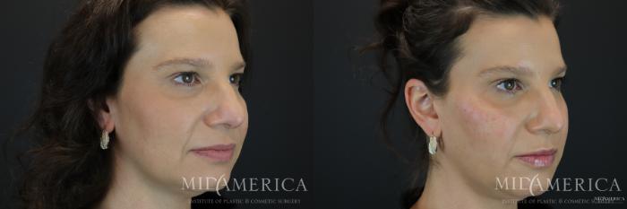 Before & After Dermal Fillers Case 165 View #1 View in Glen Carbon, IL