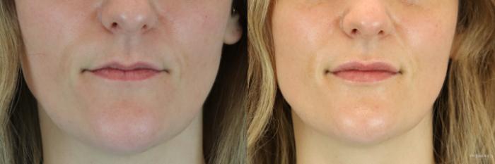 Before & After Dermal Fillers Case 205 Front View in Glen Carbon, IL