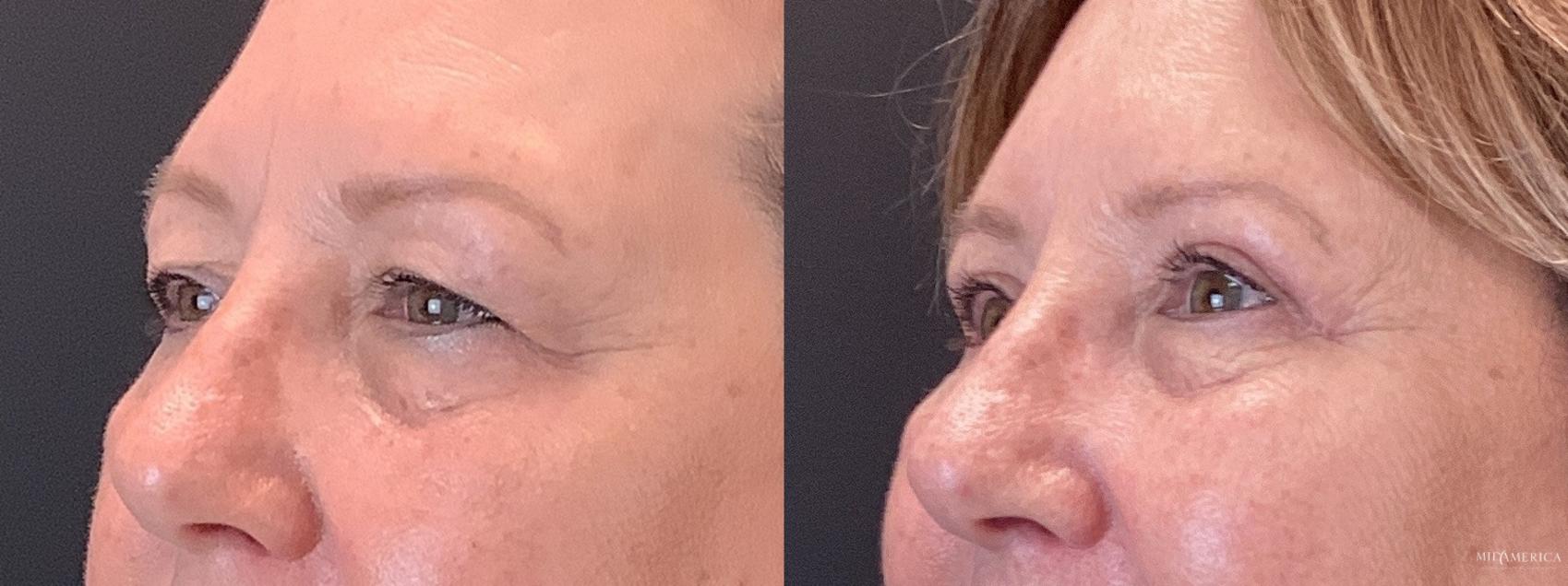Before & After Eyelid Surgery Case 351 Left Side View in St. Louis, MO