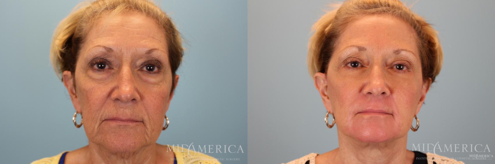 Before & After Facelift Case 30 View #1 View in Glen Carbon, IL