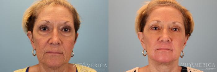 Before & After Facelift Case 30 View #1 View in St. Louis, MO