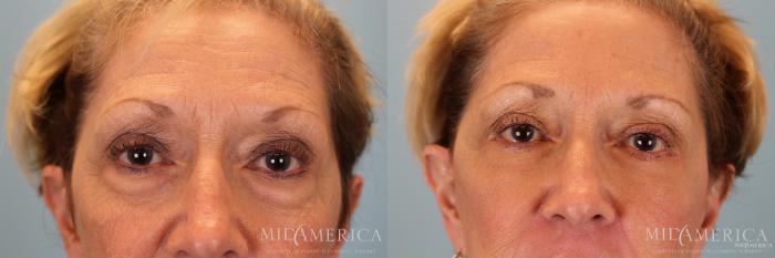 Before & After Facelift Case 30 View #2 View in St. Louis, MO