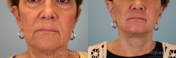 Before & After Facelift Case 30 View #3 View in St. Louis, MO