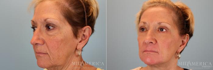 Before & After Facelift Case 30 View #4 View in St. Louis, MO