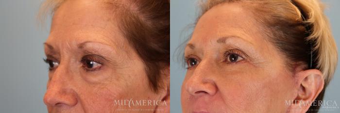 Before & After Facelift Case 30 View #5 View in St. Louis, MO