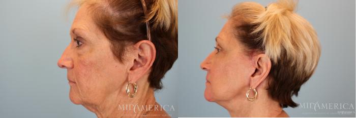Before & After Facelift Case 30 View #7 View in St. Louis, MO