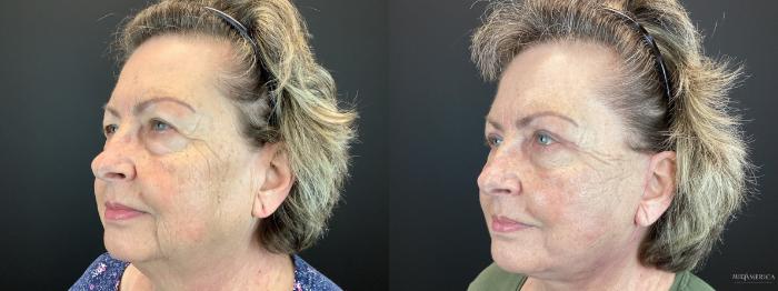 Before & After Facelift Case 307 Left Side View in St. Louis, MO