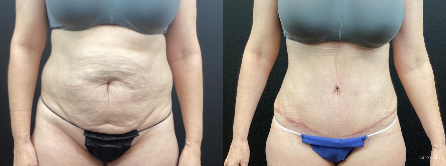 Before & After Tummy Tuck Case 334 Front View in Glen Carbon, IL