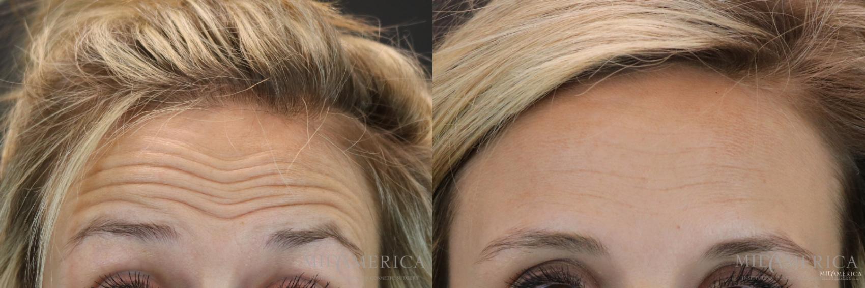 Before & After Botox/Dysport Case 154 View #1 View in Glen Carbon, IL