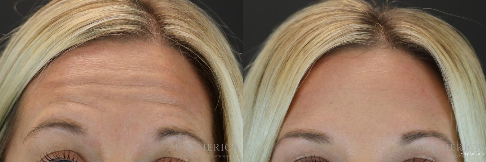 Botox/Dysport Case 155 Before & After View #1 | Glen Carbon, IL | MidAmerica Plastic Surgery