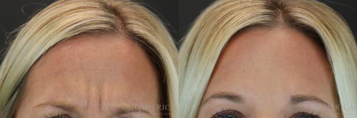 Before & After Botox/Dysport Case 155 View #2 View in St. Louis, MO