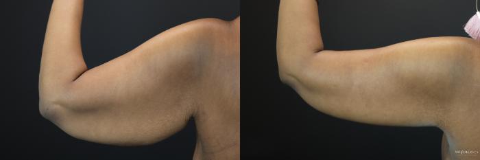 Before & After Brachioplasty Case 199 Back Left View in Glen Carbon, IL