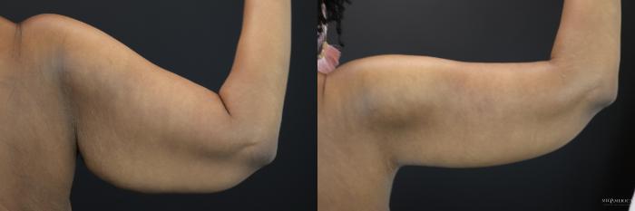 Before & After Brachioplasty Case 199 Back Right View in Glen Carbon, IL