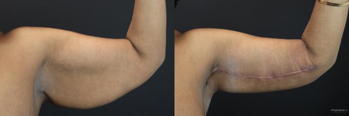 Before & After Brachioplasty Case 199 Front Left View in Glen Carbon, IL