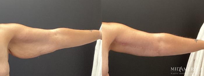 Before & After Brachioplasty Case 368 Left Oblique View in St. Louis, MO