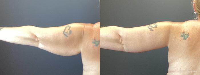 Before & After Brachioplasty Case 368 Left Side View in Glen Carbon, IL