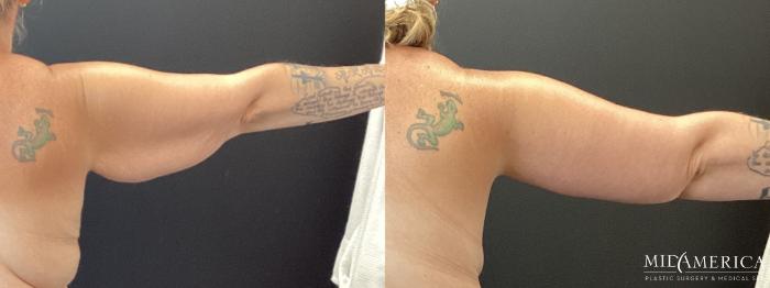 Before & After Brachioplasty Case 368 Right Side View in St. Louis, MO