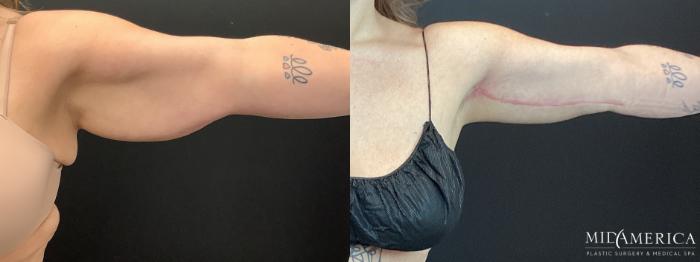 Before & After Brachioplasty Case 392 Back View in St. Louis, MO