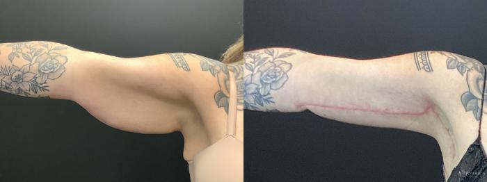 Before & After Brachioplasty Case 392 Front View in St. Louis, MO