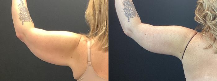 Before & After Brachioplasty Case 392 Left Oblique View in St. Louis, MO