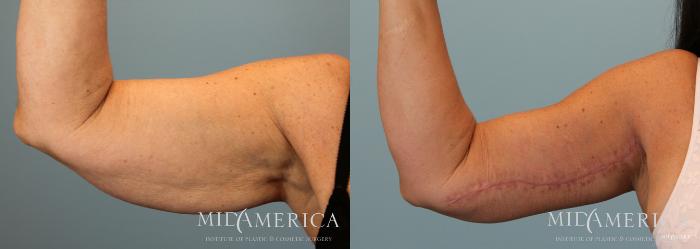 Before & After Brachioplasty Case 54 View #1 View in St. Louis, MO