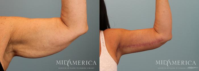 Before & After Brachioplasty Case 54 View #3 View in St. Louis, MO