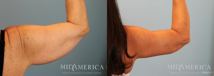 Before & After Brachioplasty Case 54 View #4 View in St. Louis, MO