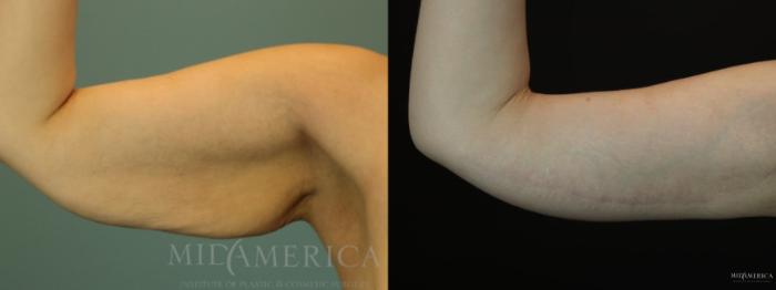 Before & After Brachioplasty Case 82 View #1 View in St. Louis, MO