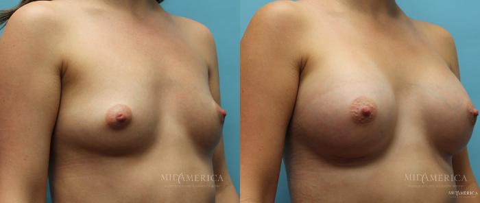 Before & After Breast Augmentation Case 10 View #2 View in St. Louis, MO