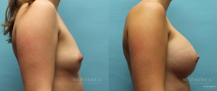 Before & After Breast Augmentation Case 10 View #3 View in St. Louis, MO