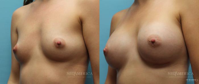 Before & After Breast Augmentation Case 10 View #4 View in St. Louis, MO
