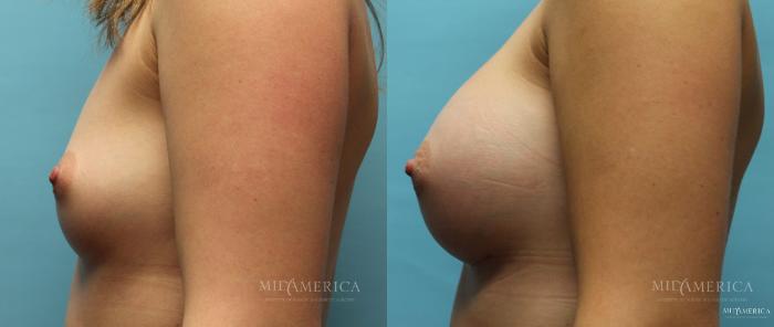 Before & After Breast Augmentation Case 10 View #5 View in St. Louis, MO