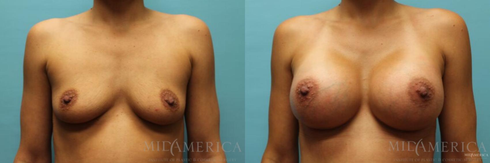 Before & After Breast Augmentation Case 101 View #1 View in Glen Carbon, IL
